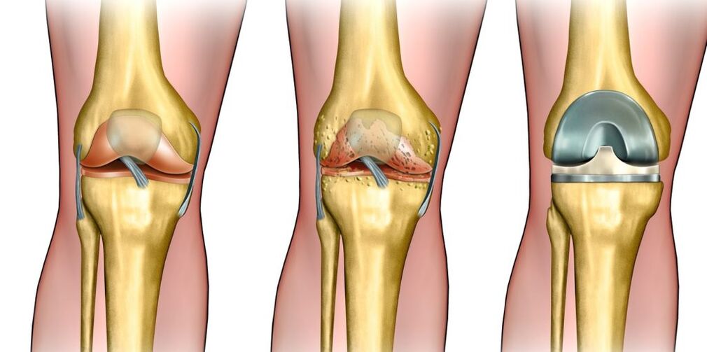 Knee joint osteoarthritis